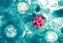 Bệnh nhiễm trùng do Cyclospora bùng phát: Nhiều bang báo cáo các trường hợp mắc bệnh tiêu chảy.
